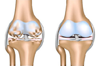 Healthy articulation and osteoarthritis