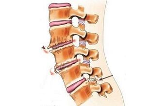 spondilartrosis as causes of back pain
