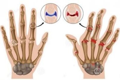 The causes of pain in the fingertips
