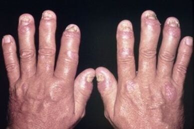 Why the fingertips hurt