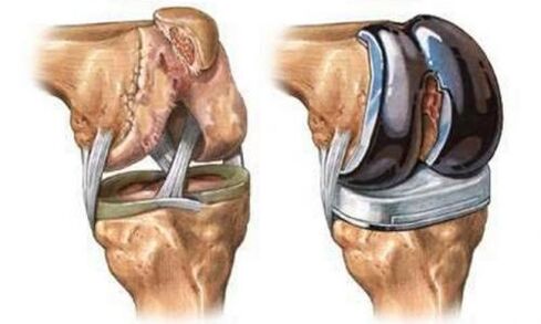 Endoprothetic knee joint for osteoarthritis