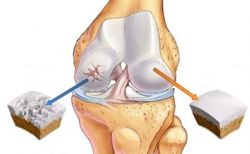 Healthy articulation and osteoarthritis of the knee joint