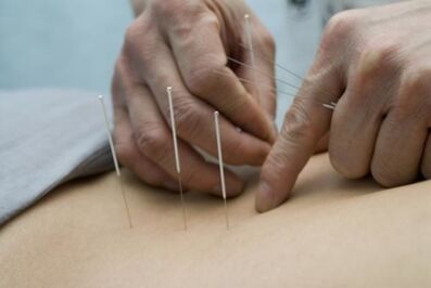 Acupuncture for osteochondrosis of the thoracic region.