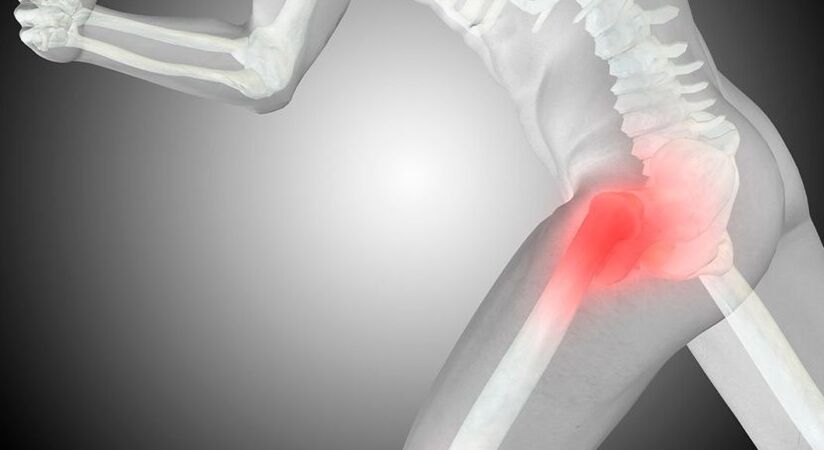 osteoarthritis of the hip joint