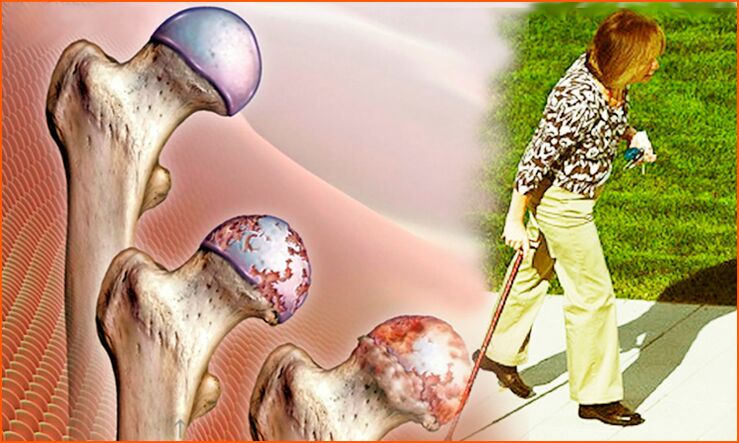 Persistent lameness in the last stage of osteoarthritis of the hip joint.