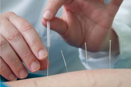 Acupuncture is a method of treating pain in the lower back caused by osteochondrosis.