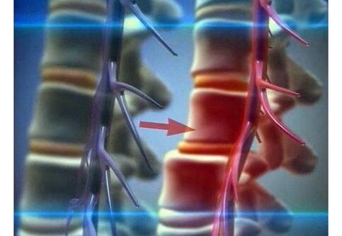 Compression of nerve endings in lumbar osteochondrosis.