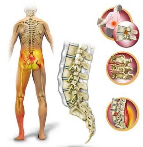 Osteochondrosis of the lumbar spine, which causes lower back pain.