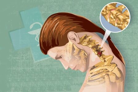 reflex symptoms of osteochondrosis