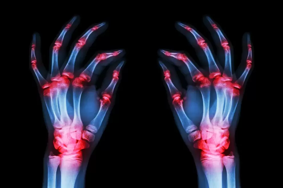 arthrosis of the finger joints