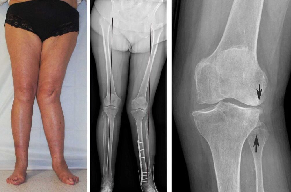 knee osteoarthritis clinical picture