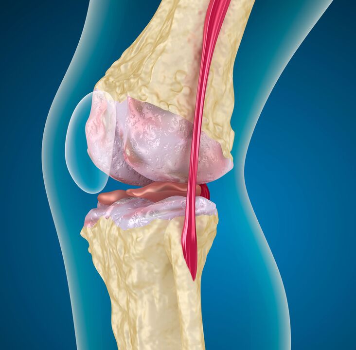 Osteoarthritis of the knee joint a degenerative dystrophic disease