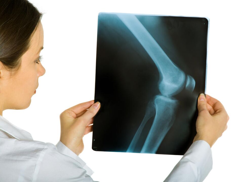 X-ray of the knee joint will reveal the presence of deforming osteoarthritis. 